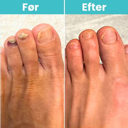 FungiClear Pro™ - Laser Neglebehandling