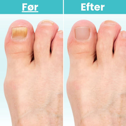 FungiClear Pro™ - Laser Neglebehandling
