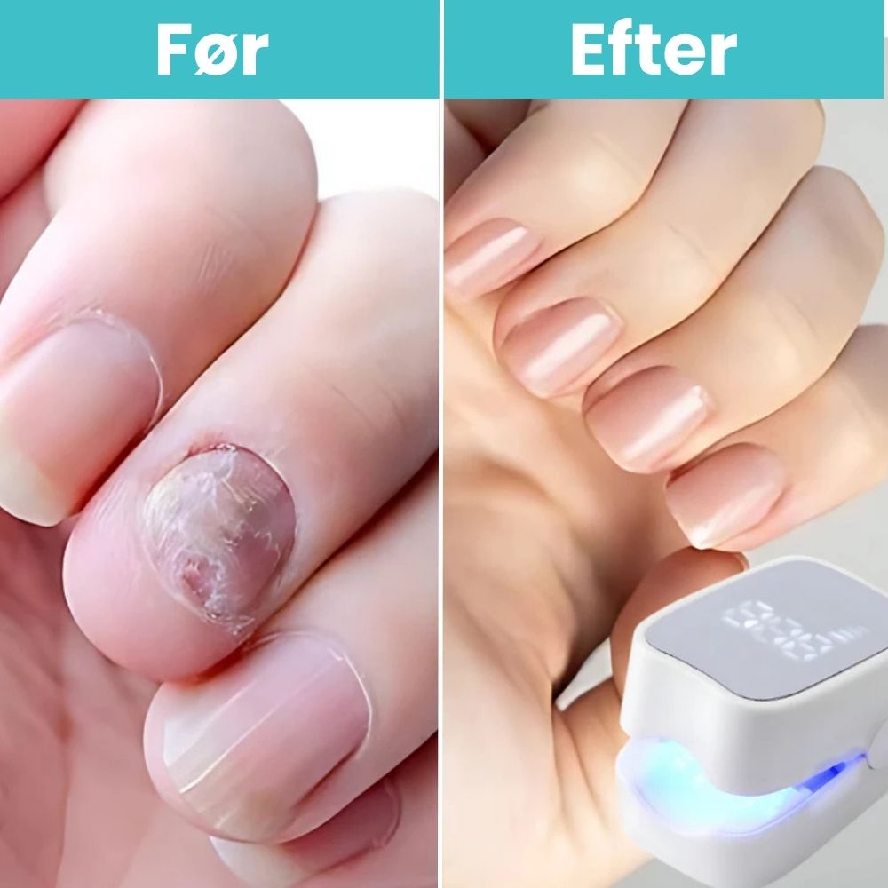 FungiClear Pro™ - Laser Neglebehandling