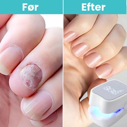 FungiClear Pro™ - Laser Neglebehandling